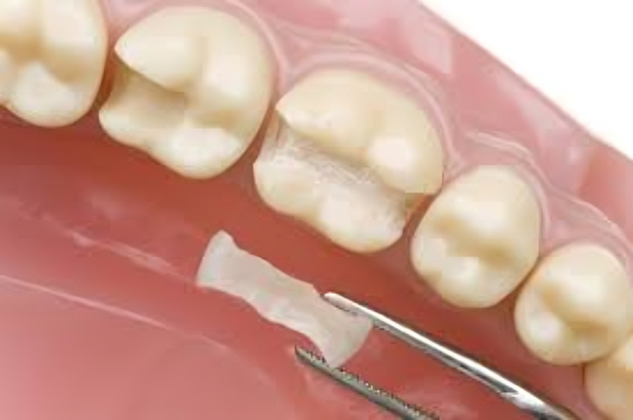 Best tooth repair treatment in Dilshad Colony