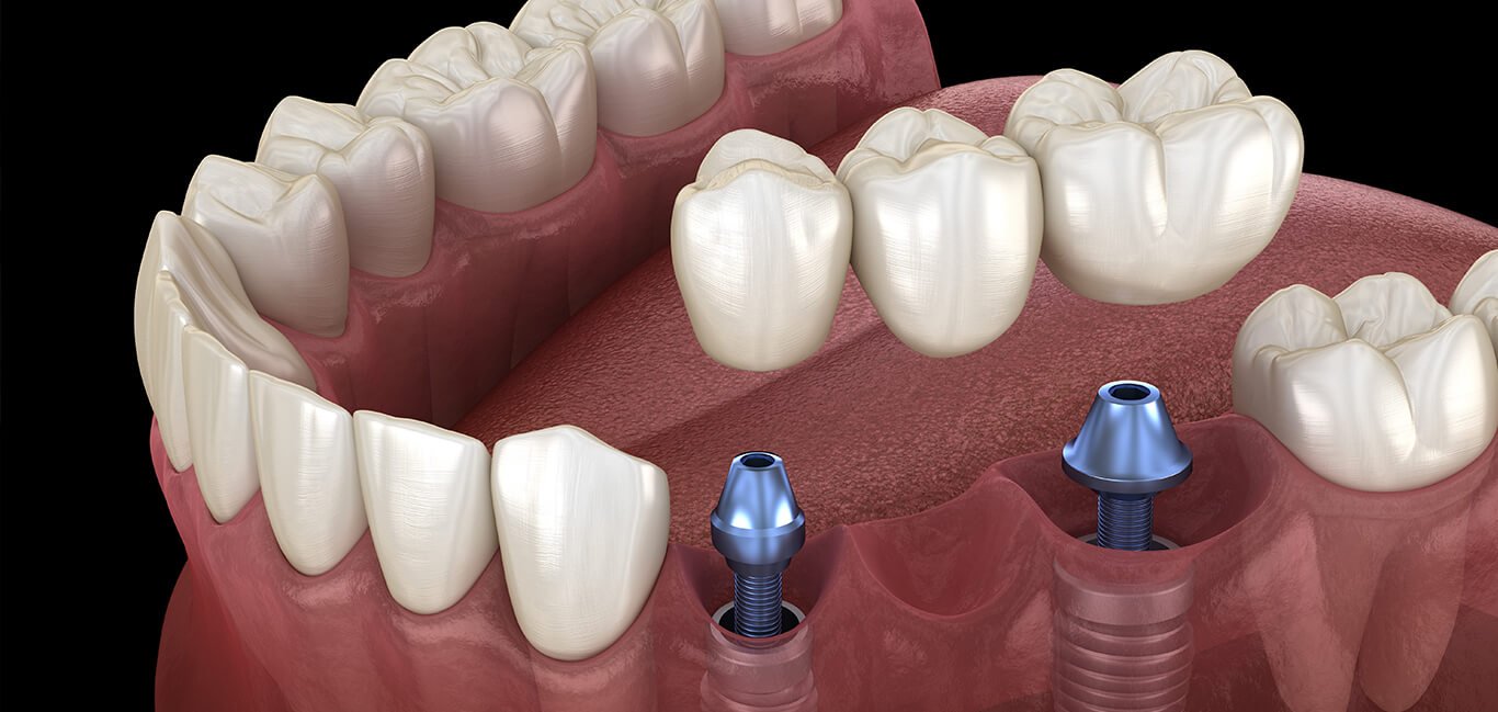 Best Dental Implants Clinic in Delhi