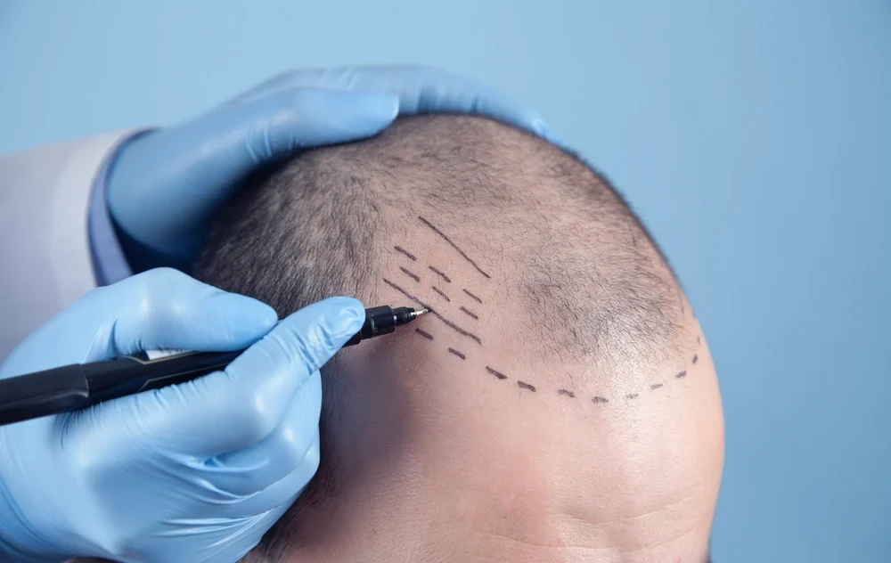 Top Hair Transplant Solutions in Dilshad Garden