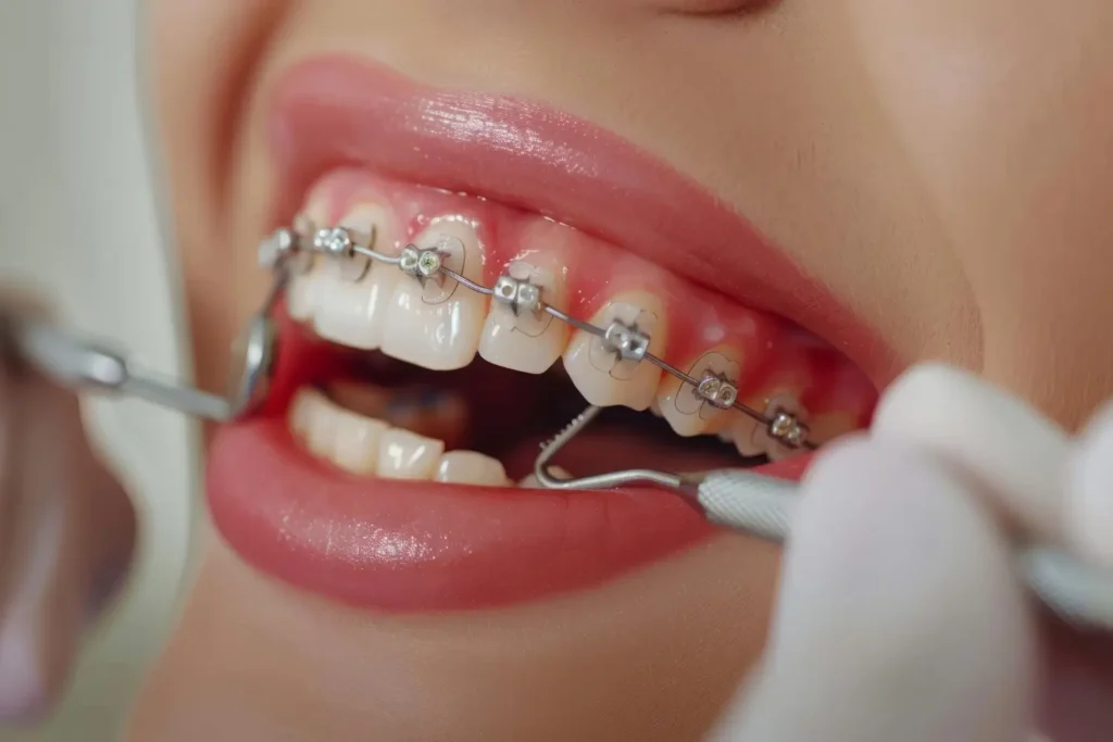 Best Orthodontic Braces Clinic in Delhi