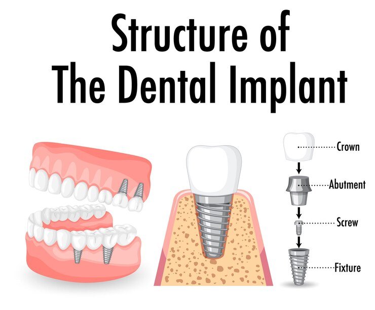 Best Dental Implants in Shalimar Garden