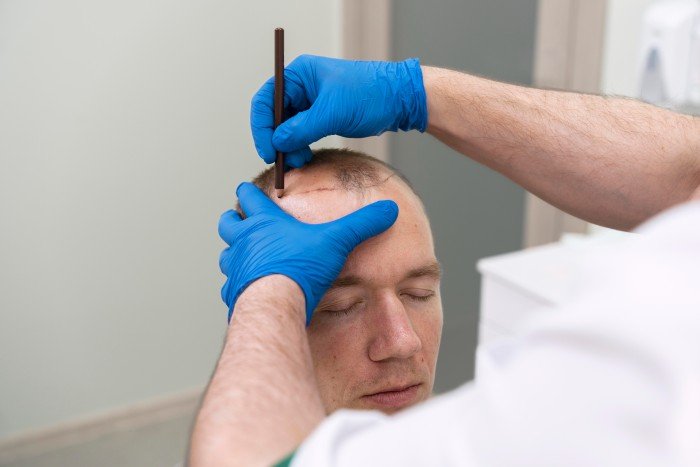 Best Hair Transplant hospital in Dilshad Garden
