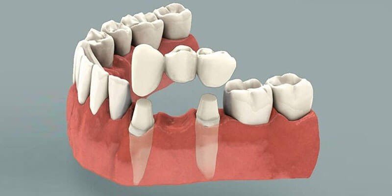 Best Crown and Bridge Treatment in East Delhi