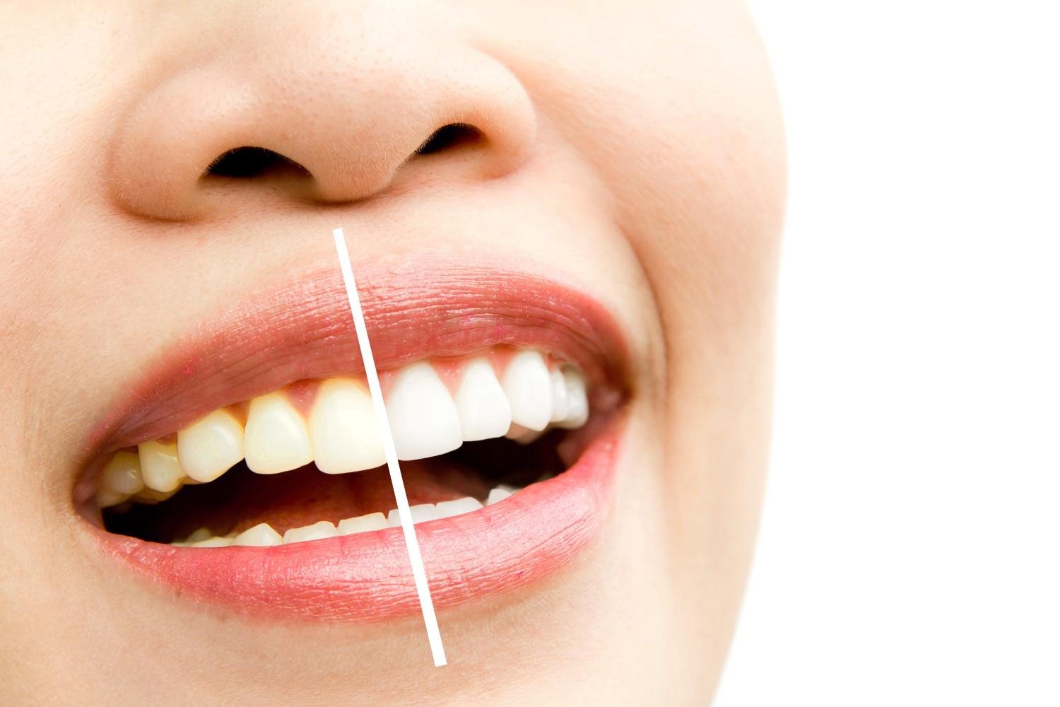 Best Tooth Whitening Hospital in East Delhi