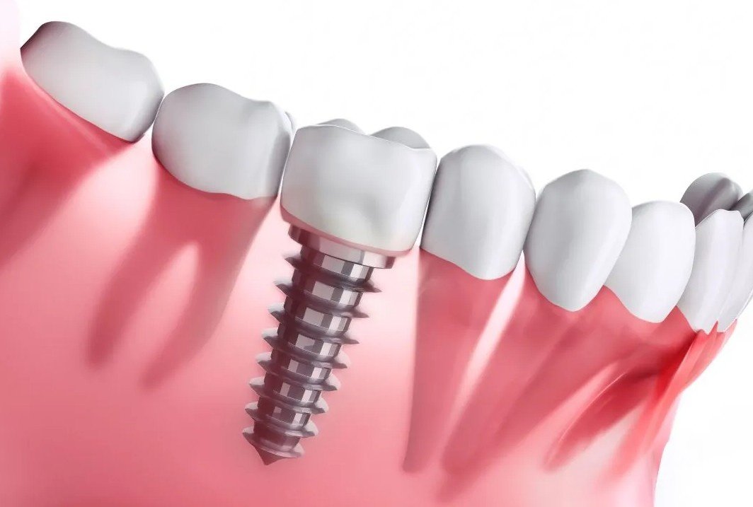 Best Dental Implant Hospital in Dilshad Garden