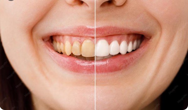 Best Teeth Whitening Hospital in East Delhi