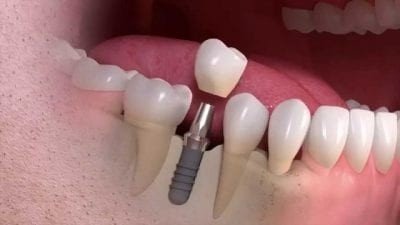 Best Dental Implant in Karkardooma
