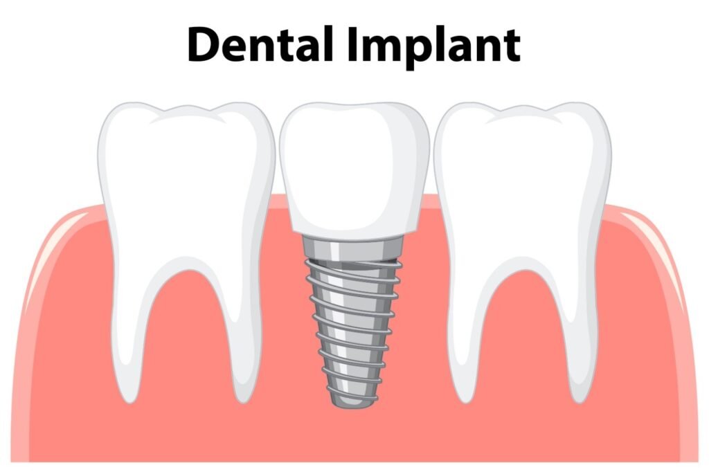 Best Hospital for Dental Implant in Dilshad Colony