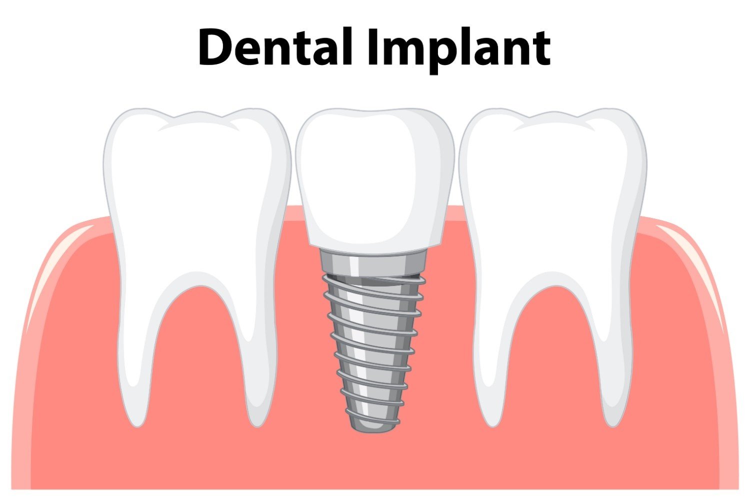 Best Hospital for Dental Implant in Dilshad Colony