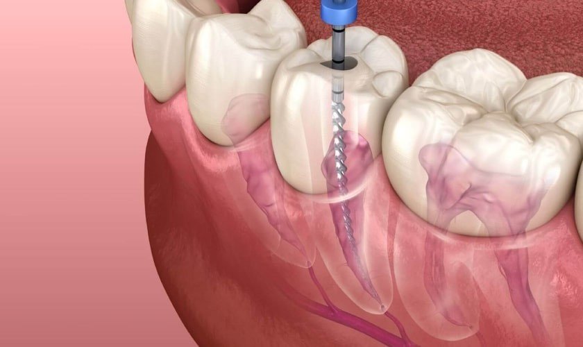 Best Root Canal Treatment in Delhi
