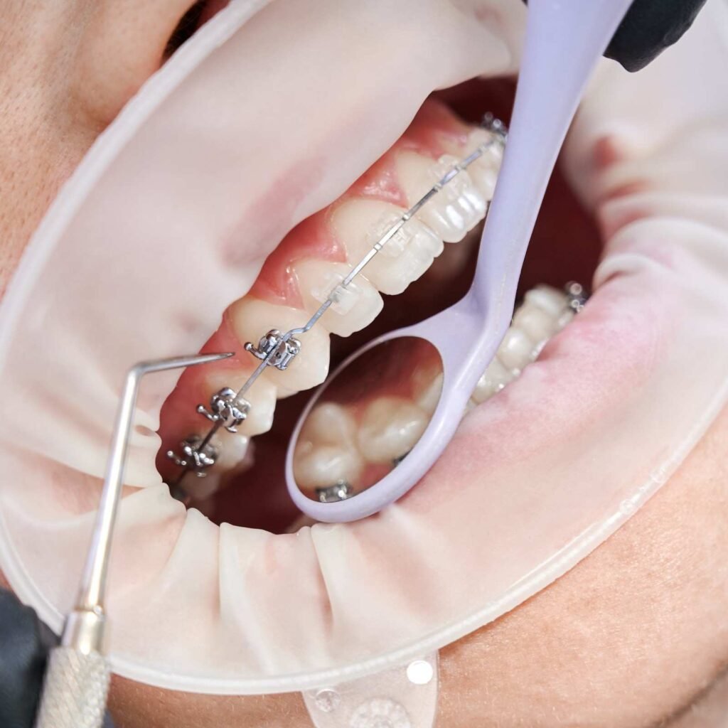 Best Orthodontic Braces Treatment in Dilshad Garden