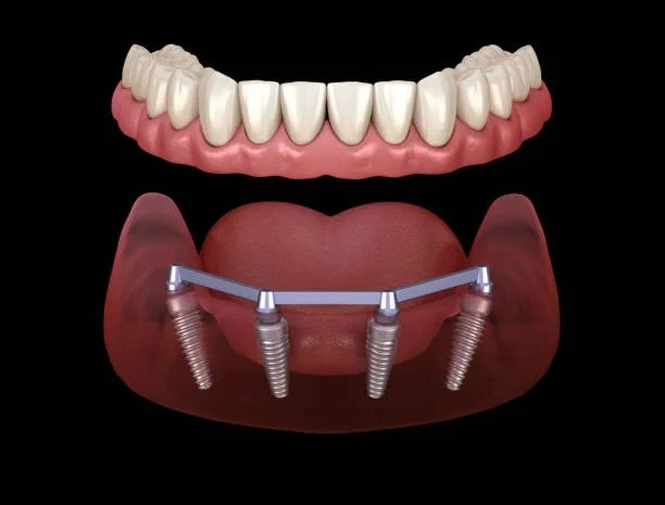 Best Dental Implants in Dilshad Garden
