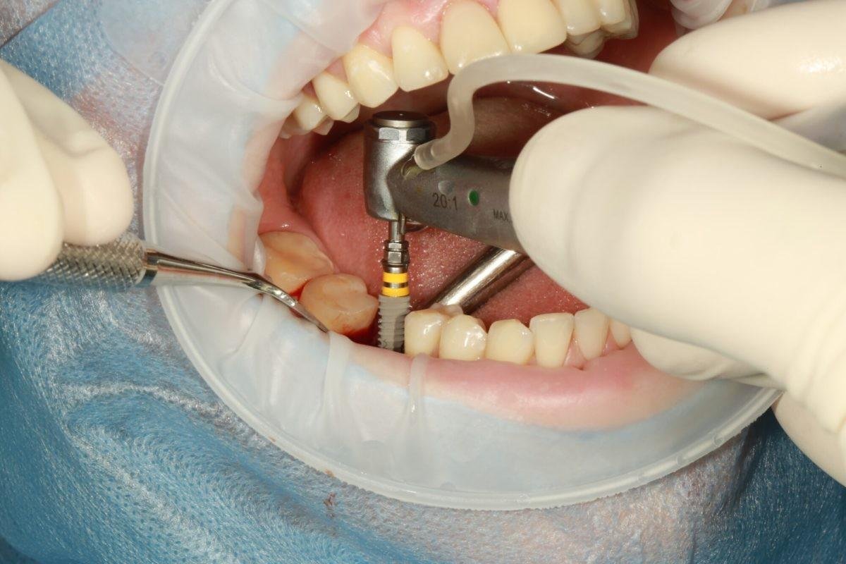 Best Dental Implant Specialist in Delhi