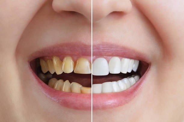 Cosmetic Dentist in East Delhi